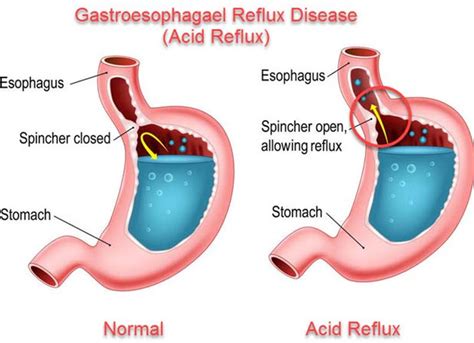 Acid Reflux & Semaglutide