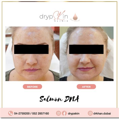 Salmon DNA Injections | Salmon DNA Dubai | drypSKin