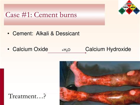 PPT - Chemical Burns PowerPoint Presentation, free download - ID:590440