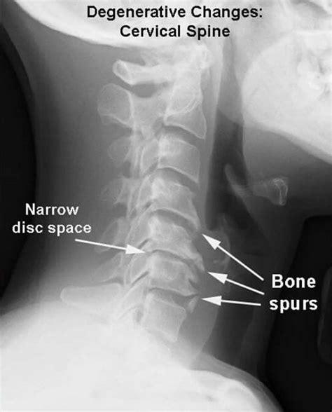 Spondylosis, definition, causes, symptoms, diagnosis, treatment