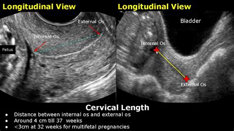 How To Measure Cervical Length On Ultrasound | Transabdominal And Transvaginal Views | Cervix ...