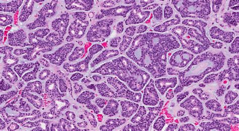 Carcinoma adenoideo cistico | MyPathologyReport.ca