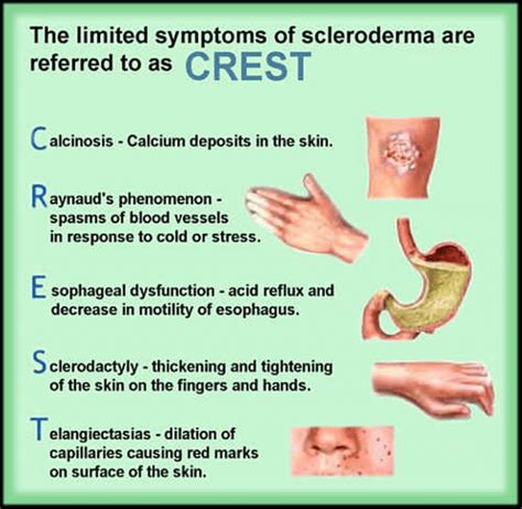 Scleroderma - Myositis Support and Understanding