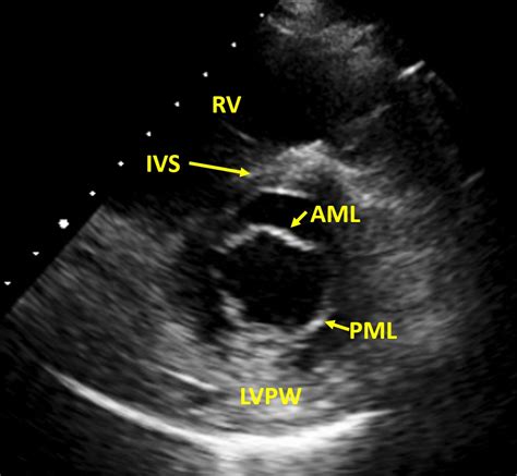 Normal mitral valve cross section on echocardiography – All About Cardiovascular System and ...