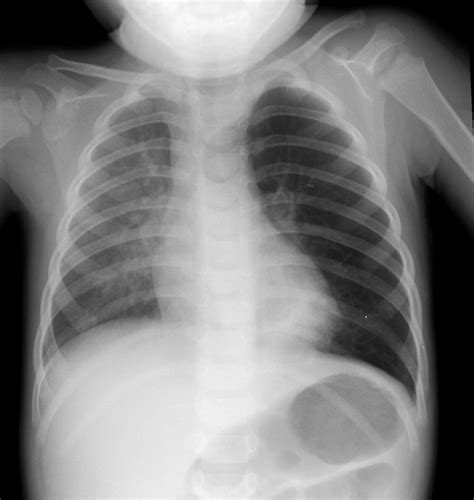 chest x-ray child - Pediatric Pulmonologists