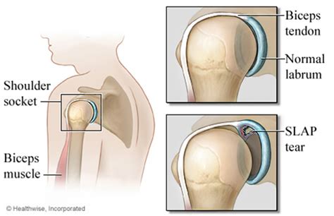 Slap Tear | Brisbane Knee and Shoulder Clinic | Dr MacgroartyBrisbane Knee and Shoulder Clinic