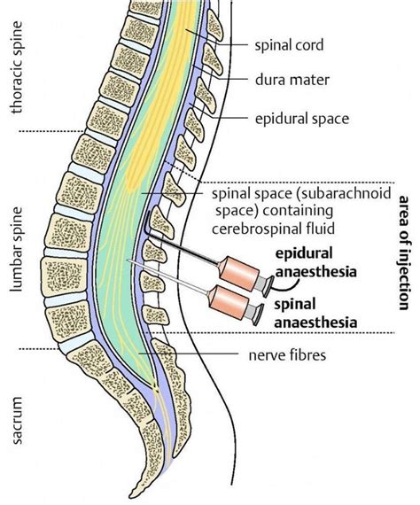 Difference Between Epidural And Spinal Injection S Nu - vrogue.co