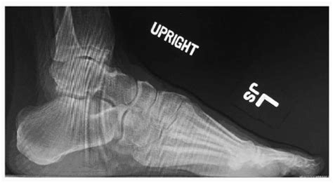 Hindfoot-Driven Cavovarus Deformity | Musculoskeletal Key