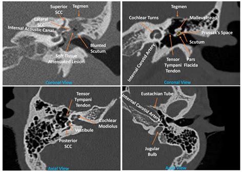 SCOTLAND preoperative tympanomastoid CT temporal bone mnemonic system ...