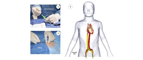 Cpt code atrial flutter ablation - tellFlex