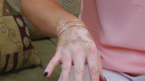 World Vitiligo Awareness Day aims to educate others on skin disease | WLOS