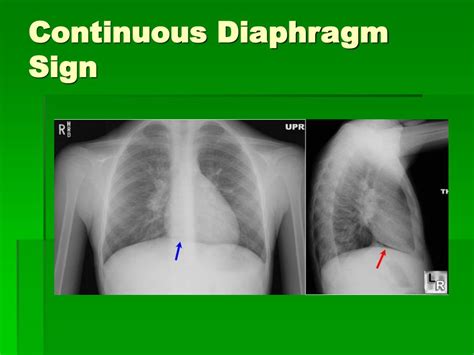 PPT - Pneumomediastinum PowerPoint Presentation, free download - ID:380076