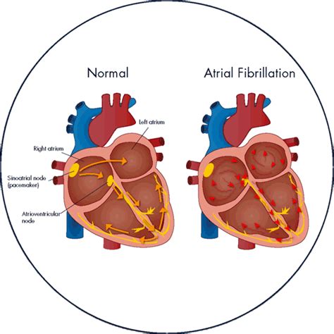 What is Atrial Fibrillation? - AFib Institute