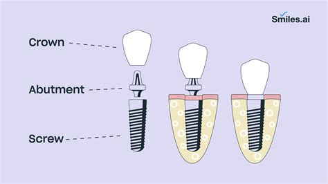 The Dental Implant Procedure – Explained Step by Step