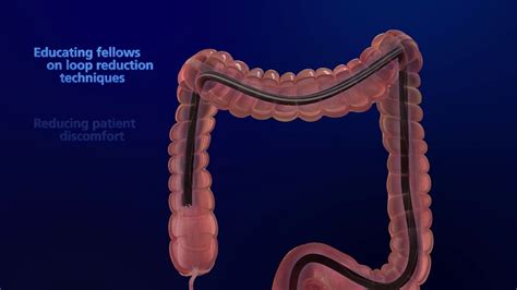 Colonoscopy Scope 3D Animation Video - YouTube