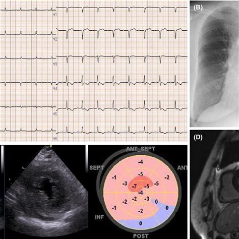 Pathological results of the first endomyocardial biopsy.... | Download Scientific Diagram