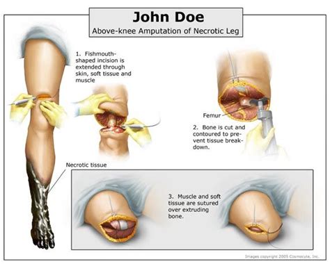 Above-knee amputation of necrotic leg | Below the knee amputation, Medical illustration ...