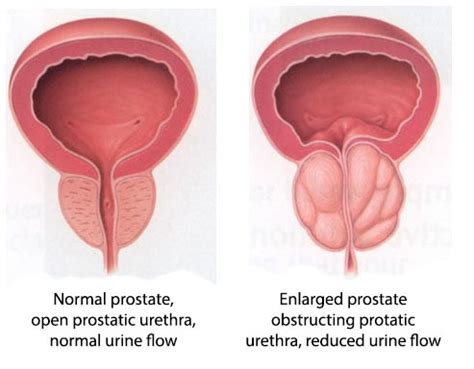 Prostate Enlargement (BPH): Symptoms, Diagnosis & Treatment Sydney