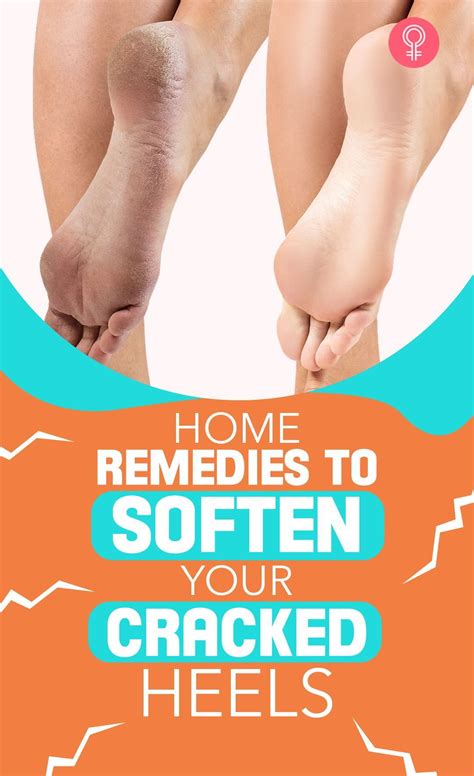 Foot Cream Recipe, Homemade Foot Cream, Dry Heels, Diy Treatment, Feet Treatment, Heal Cracked ...