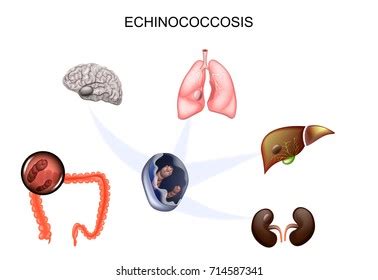 406 Cyst Brain Images, Stock Photos & Vectors | Shutterstock