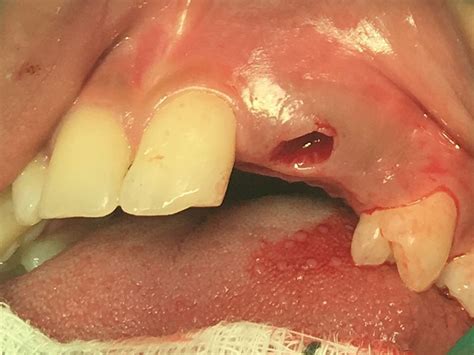 Tooth avulsion | The BMJ