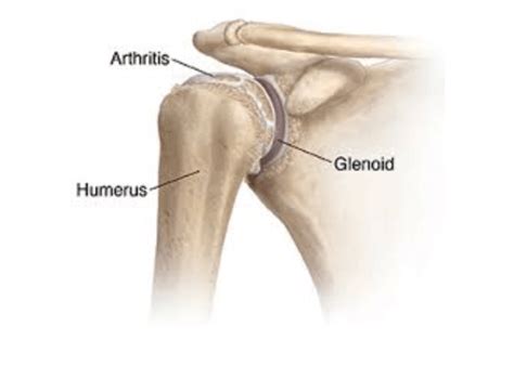 Glenohumeral Osteoarthritis | Hawaii Sports & Balance Center