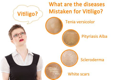 How Vitiligo Affects An Individual Life?: Symptoms and Causes of Leucoderma