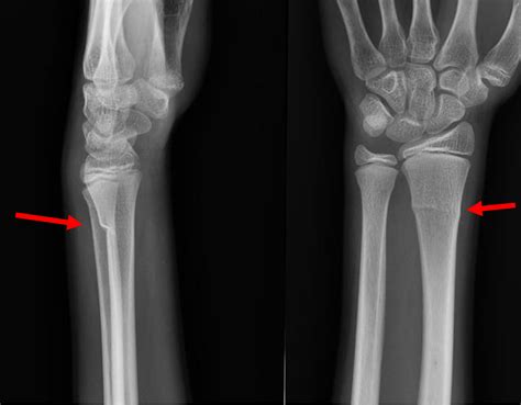 Impacted Distal Radius Fracture