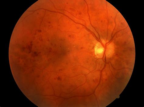 Diabetic Retinopathy Exams in Primary Care - Physician's Weekly