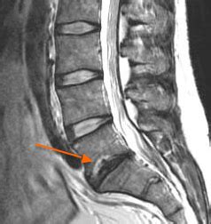 L5 S1 Disc Degeneration Symptoms