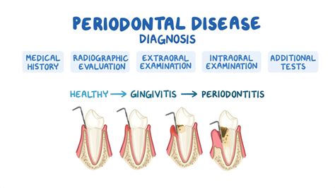 Diagnosis of periodontitis: Video, Anatomy & Definition | Osmosis