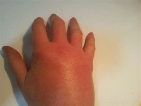 Bee Sting Swelling - Treatment, Pictures, Home Remedies