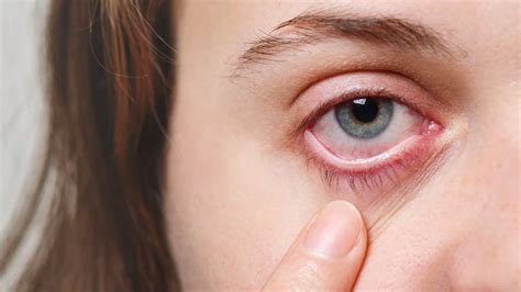 Sunken Eyes - Causes, Symptoms And Remedies | OnlyMyHealth