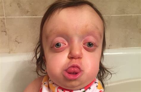 Girl born with severely deformed head smiles despite strangers ...