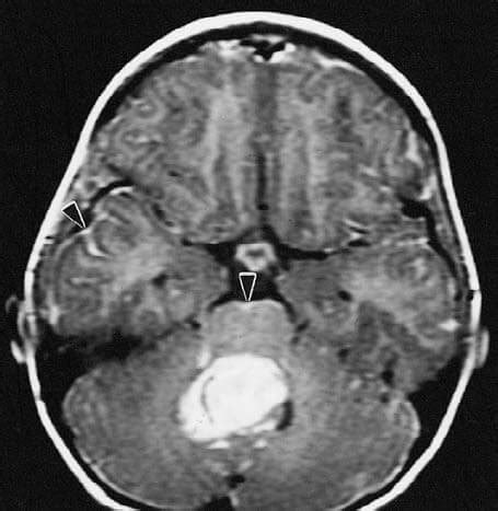 Medulloblastoma - Brain Tumour Foundation of Canada