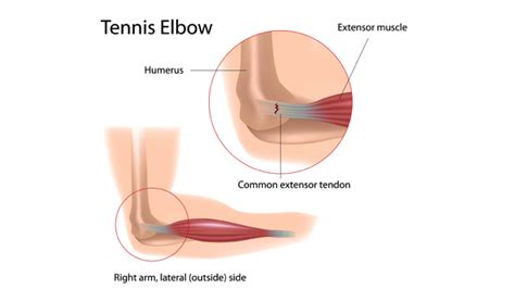 Tennis Elbow