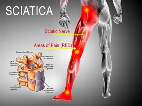 Blog | Figuring Out the Right Treatment for Your Sciatica Symptoms