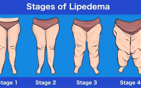 Lipedema Treatment by Pain & Swelling Solutions Lymphatic Massage for Plastic Surgery Recovery ...