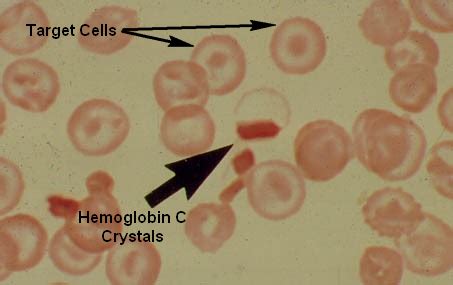 Hemoglobin C Diease and Trait laboratory diagnosis | Medical Laboratories