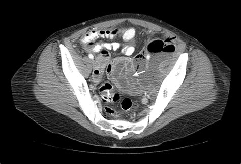 Pelvic Ct Scan