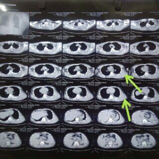 CT scan of thorax of the patient on day of presentation | Download ...