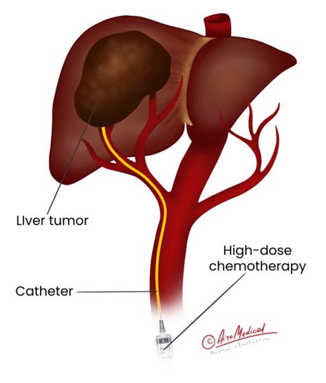 Liver Cancer Transarterial Chemoembolization (TACE)