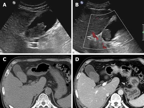 Gallbladder Ultrasound Sludge