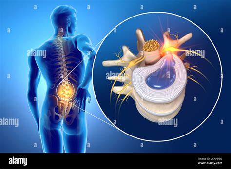 Herniated Nucleus Pulposus