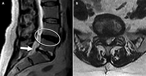 Recurrent L5 S1 Disc Herniation - mapageprek