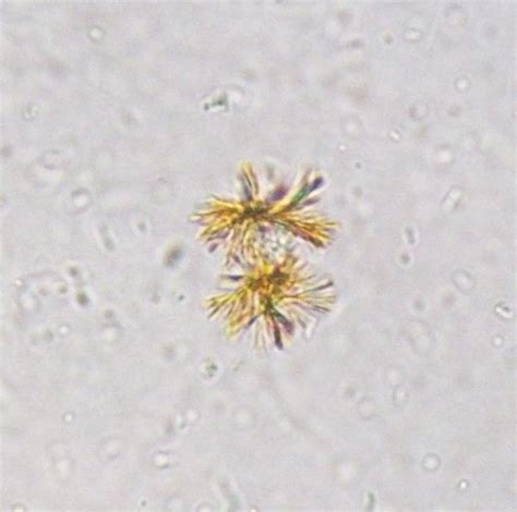 Tyrosine Crystals In Urine