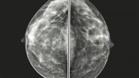 What Does Breast Cancer Look Like On A Mammogram