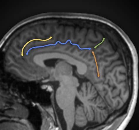 Paracentral Lobule Mri