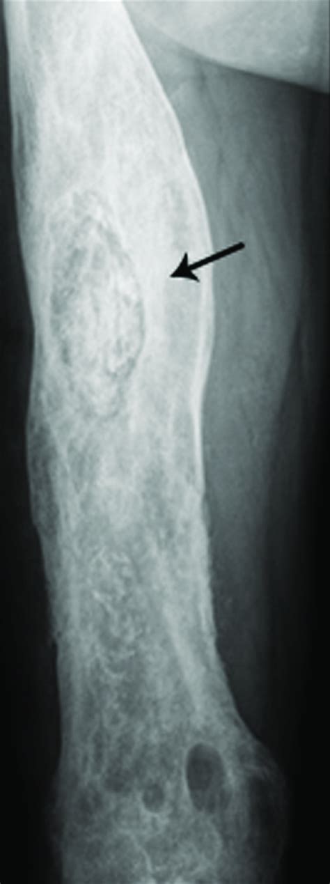 Chronic osteomyelitis on plain radiograph of the femur. Plain... | Download Scientific Diagram