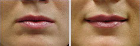 Collagen Lips Before After Pictures | Lipstutorial.org